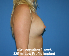 plastic-surgery-breast-augmentation